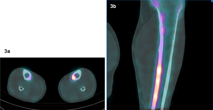 Fig 3a and 3b. Linear increased uptake in the posteromedial tibial shaft. Normal CT appearances.