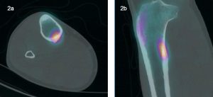 Focal uptake in right proximal tibia on SPECT-CT