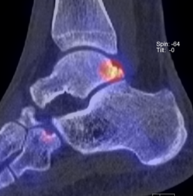 SPECT-CT of ankle