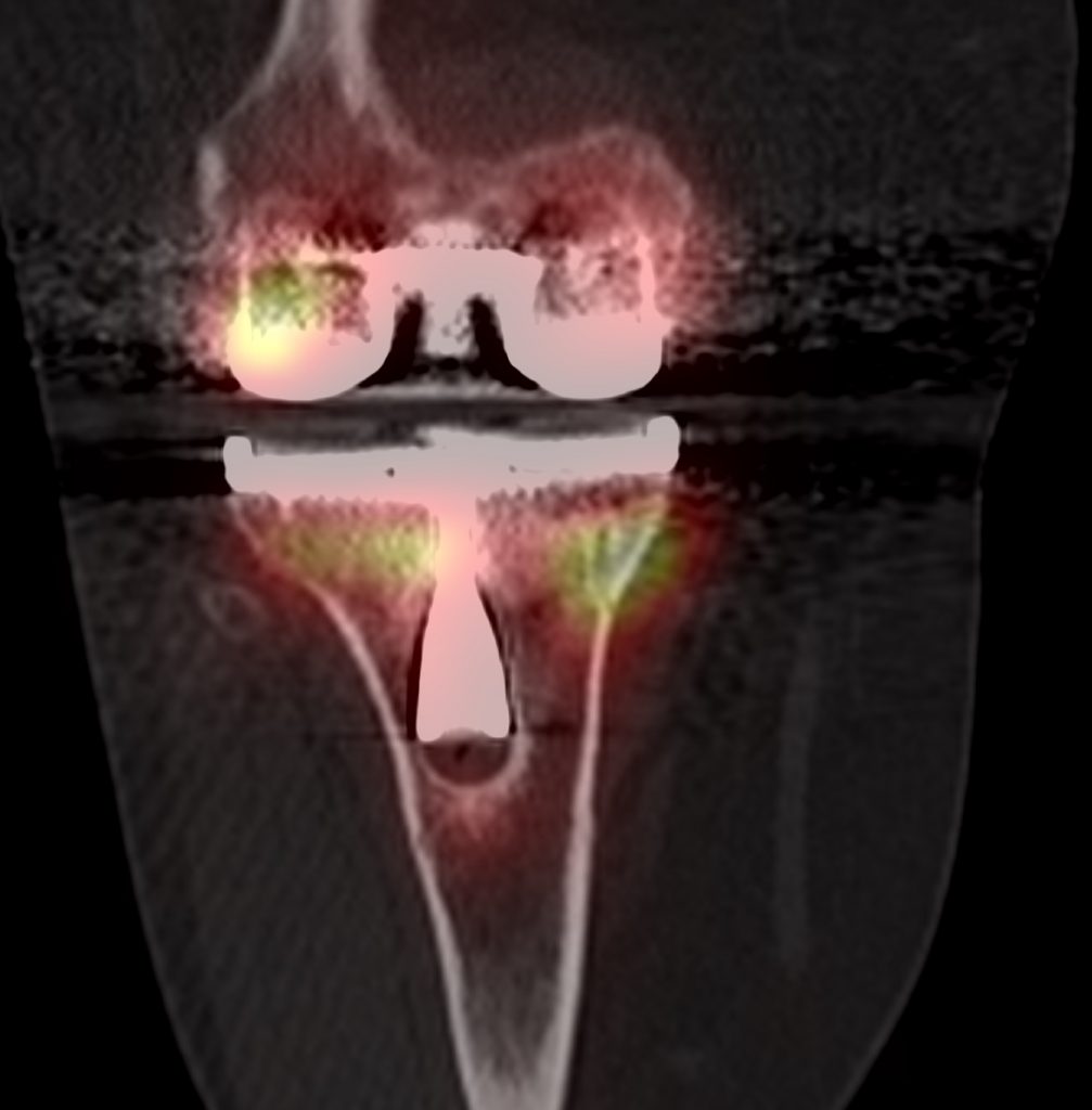 Bone SPECT-CT of the knee showing loosening