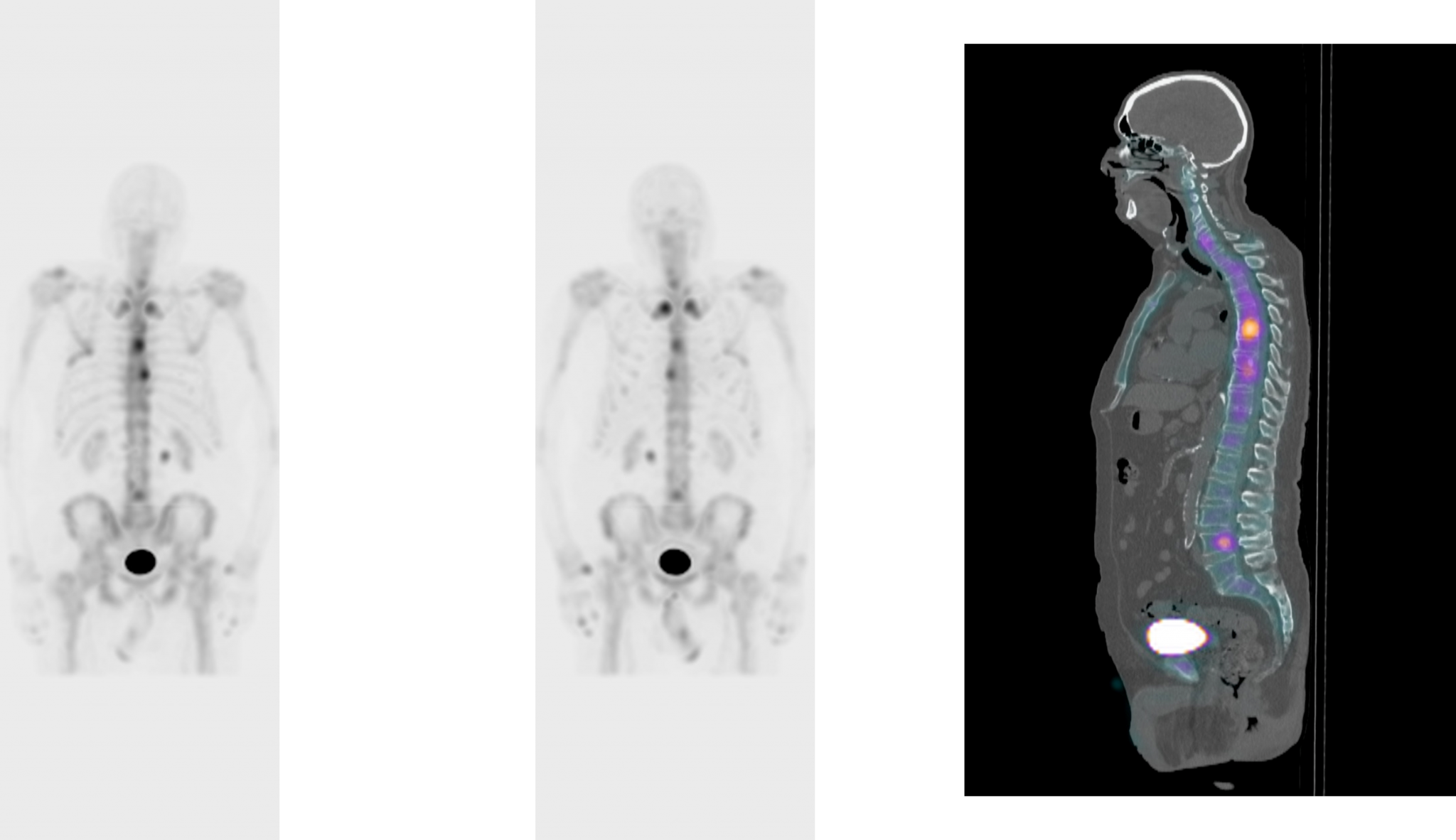 nuclear-medicine-studies-whole-body-bone-spect-ct-scans-for-cancer